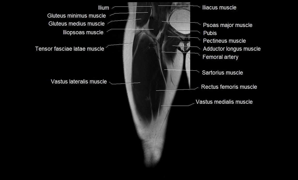 MRI thigh coronal cross sectional anatomy image 6.webp